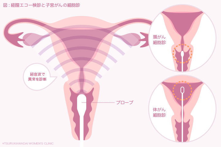 経膣エコー検診と子宮がんの細胞診